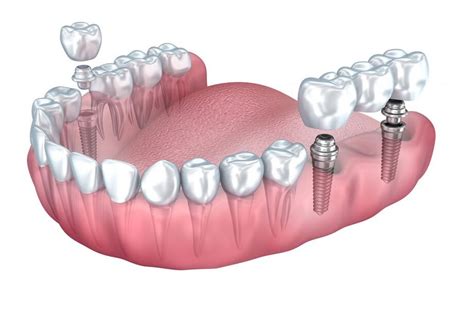 Dental Bridge vs Implant Cost | Dental Associates of Lodi