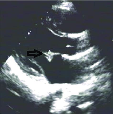 Myxomatous Degeneration Of Mitral Valve Prolapse Mitral Valve | Images ...