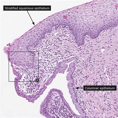 normal transformation zone histology cervix | Cervix, Teaching biology ...