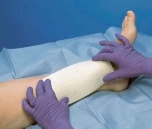 Leg Ulcers » The Vein Clinic