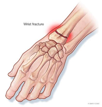 Hand & wrist fractures - Overview - Mayo Clinic Orthopedics & Sports ...