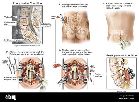 Spondylolisthesis Surgery L5 S1