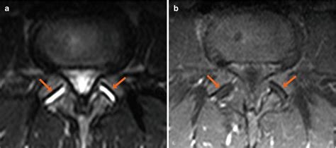 Facet Joint Effusion | Radiology Key