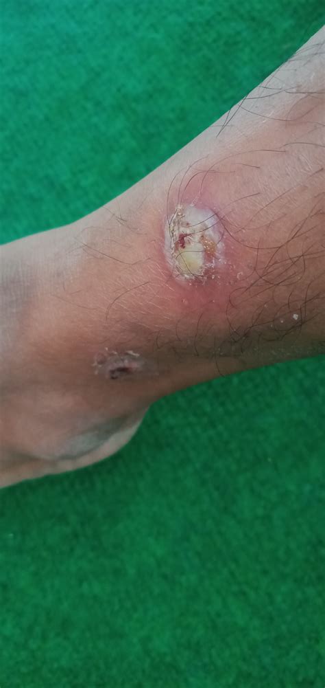 6 Gejala Scabies (Kudis) serta Tanda-Tanda Sembuhnya