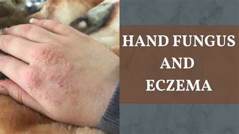 Hand Fungus and Eczema | Eczemaless