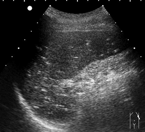 Abnormal Spleen Ultrasound