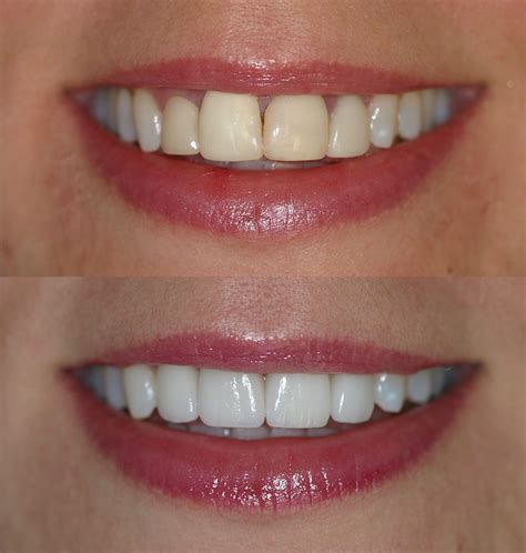 Before & After Porcelain Veneers - Cosmetic Dentists of Houston ...