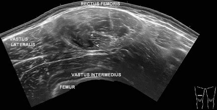 Rectus femoris muscle injury | Radiology Case | Radiopaedia.org