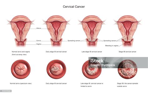 Cervical Cancer Stages Stock Photo - Download Image Now - Cervix ...