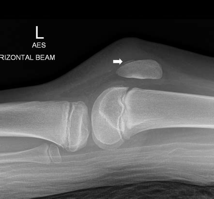 Patella sleeve avulsion fracture | Radiology Case | Radiopaedia.org