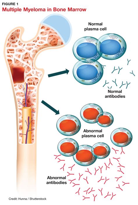 Diagnosing Multiple Myeloma in Primary Care | Clinician Reviews