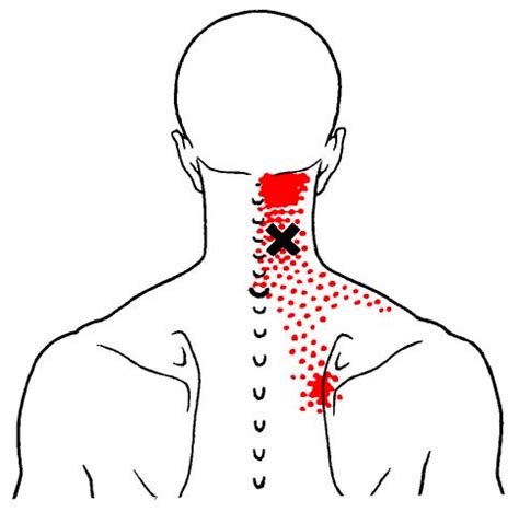 What are Muscle Knots and How Can we Prevent Them? - Back to Health ...