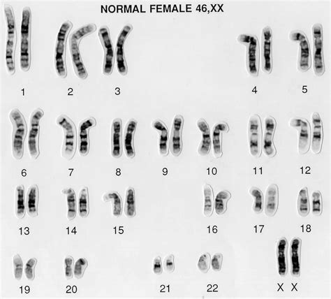 Karyotype, karyotype test & analysis, normal karyotype & abnormal karyotype