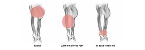 Diagnosing Lateral Thigh Pain: IT band syndrome, Hip Bursitis and ...