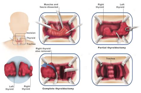 Thyroid and Parathyroid Surgery - Dr. Ahmed Farah Abdulrahman