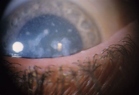 Corneal Dystrophy, Macular | Hereditary Ocular Diseases