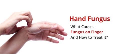 Fungus on Fingers (Hand Fungus): Causes, Symptoms, Treatments