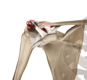 Acromioclavicular Joint Osteoarthritis Houston, TX | AC Joint ...