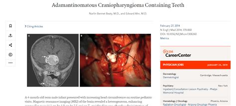 Teratoma Tumor: The demonic mass that grows teeth, eyes, feet, and ...