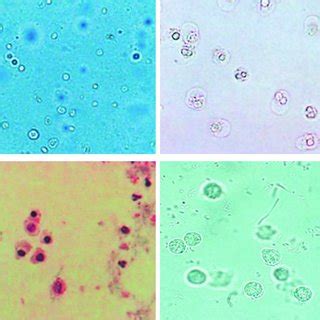 False Positive and False Negative of Leucocyte Esterase and Nitrite in ...