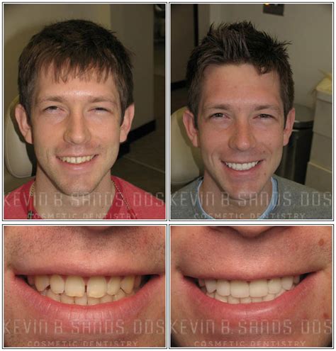 Porcelain Veneers Before and After