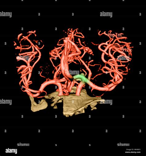 CT Angiogram of Aneurysm Stock Photo - Alamy