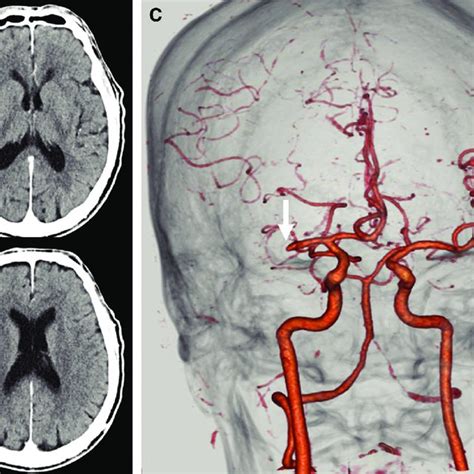 Preoperative plain and contrast-enhanced head CT. (A, B) Axial view of ...