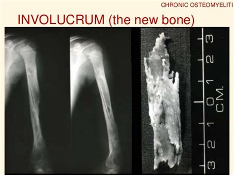 Osteomyelitis