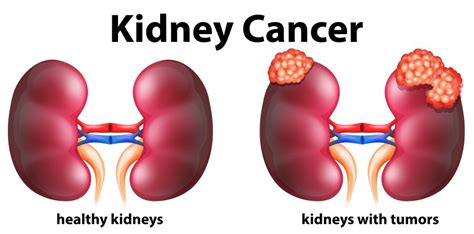 Studies On Cannabis And Kidney Cancer