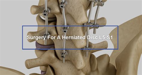 Surgery For A Herniated Disc L5-S1 - Dr. Kevin Pauza, The Discseel ...