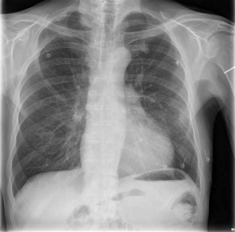 Mediastinal Lymph Nodes