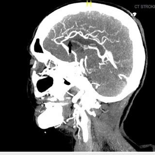 CT angiogram of head and neck showing the sagittal view of the middle ...