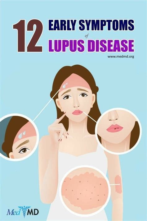 Lupus in women | Lupus facts, Lupus symptoms, Lupus rash