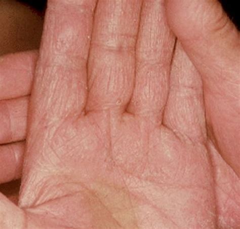 Hand Fungus - Pictures, Symptoms, Treatment and Causes - (2018 - Updated)