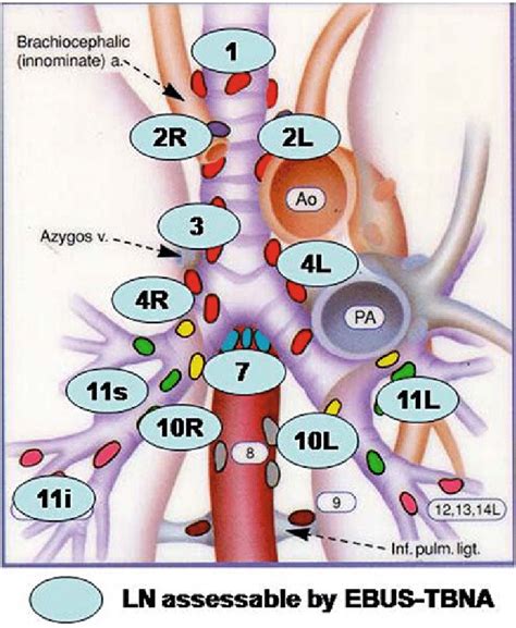 Mediastinal Lymph Node Levels