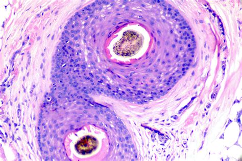 Scarring Alopecia Histology