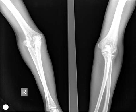 X-ray of the patient showing radial head dislocation. | Download ...