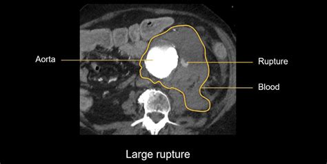 Abdominal CT: aortic aneurysm • LITFL • Radiology Library