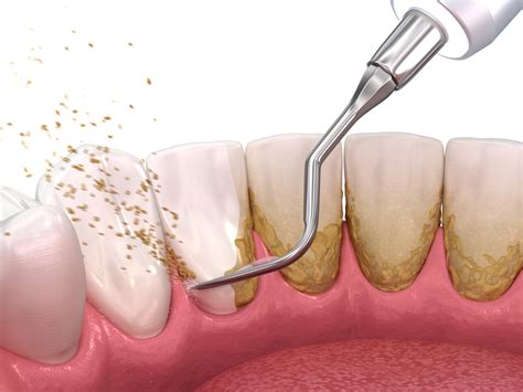 Difference Between Plaque and Tartar - Pickett Family Dental