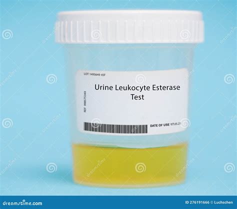 Urine Leukocyte Esterase Test Stock Photo - Image of cells, blood ...