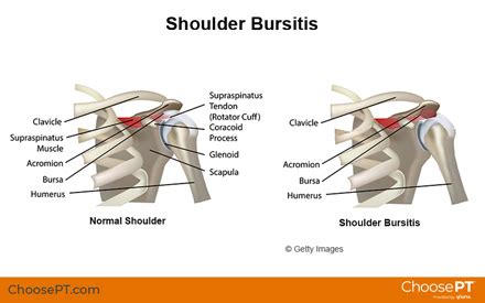 Shoulder Bursitis Injury Treatment Guide | The Best Porn Website