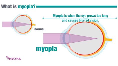 Myopia Treatment for Children in Chicago | Eye Society