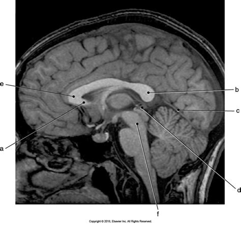 Midsagittal Brain MRI Diagram | Quizlet