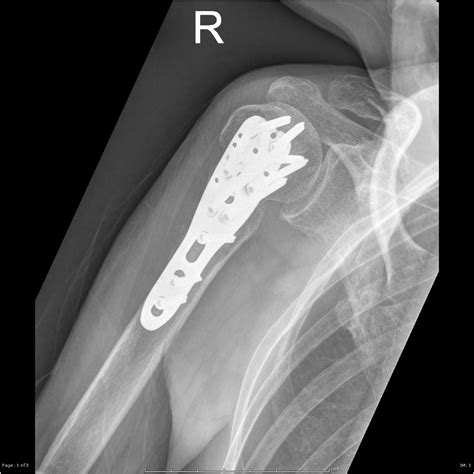 Proximal Humerus Neck Fracture