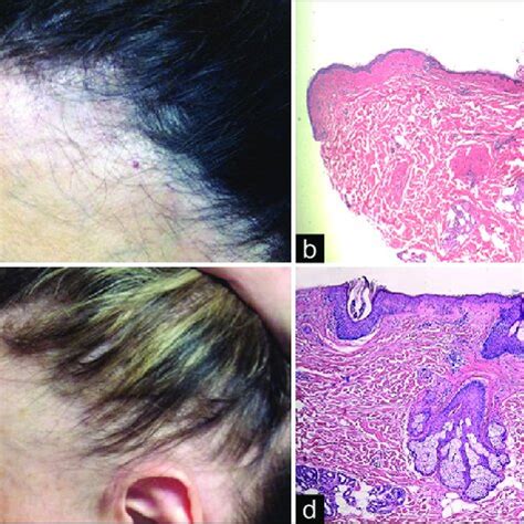 (a) Lateral view of frontal fibrosing alopecia Patient 1. Patient 1 had ...