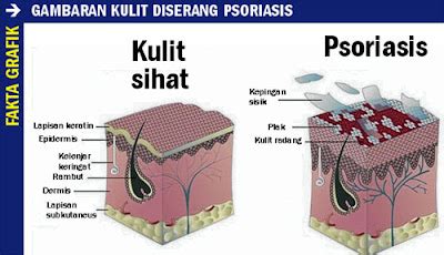 Penyakit kulit psoriasis - Sel kulit mati tidak sekata ~ MY ADHA