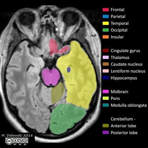 Brain lobes - annotated MRI | Radiology Case | Radiopaedia.org ...