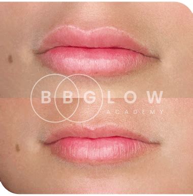 BB Glow Academy Hyaluronic lip filler training | BB Glow Academy | Get ...