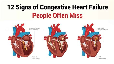 12 Signs of Congestive Heart Failure People Often Miss | 7 Minute Read