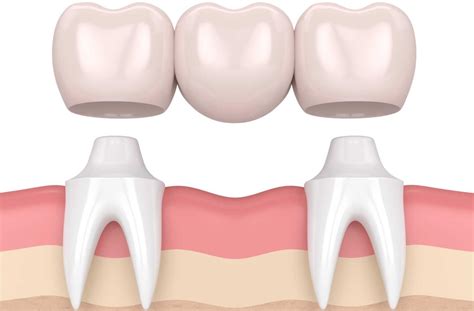 Dental Bridge Procedure